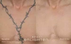 Enlighten Panama City Tattoo Removal at Sun Dermatology