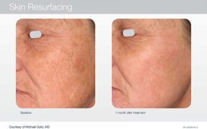Acupusle Laser Treatments in Panama City at Sun Dermatology