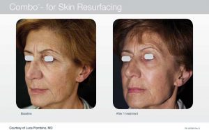 Acupusle Laser Treatments in Panama City at Sun Dermatology