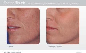 Acupusle Laser Treatments in Panama City at Sun Dermatology