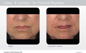 Acupusle Laser Treatments in Panama City at Sun Dermatology