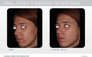 Acupusle Laser Treatments in Panama City at Sun Dermatology