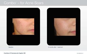 Acupusle Laser Treatments in Panama City at Sun Dermatology