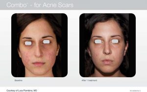 Acupusle Laser Treatments in Panama City at Sun Dermatology
