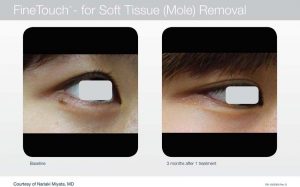 Acupusle Laser Treatments in Panama City at Sun Dermatology