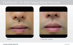 Acupusle Laser Treatments in Panama City at Sun Dermatology