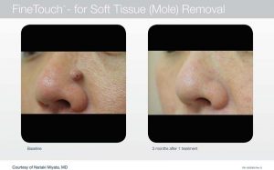 Acupusle Laser Treatments in Panama City at Sun Dermatology