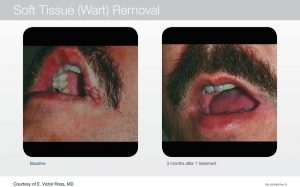 Acupusle Laser Treatments in Panama City at Sun Dermatology