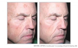Halo Laser and BBL Laser Treatments in Panama City at Sun Dermatology