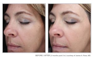 Halo Laser and BBL Laser Treatments in Panama City at Sun Dermatology