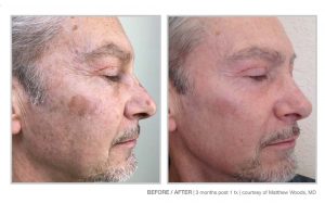 Halo Laser and BBL Laser Treatments in Panama City at Sun Dermatology