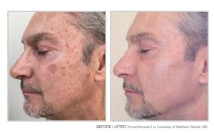 Halo Laser and BBL Laser Treatments in Panama City at Sun Dermatology