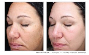 Halo Laser and BBL Laser Treatments in Panama City at Sun Dermatology
