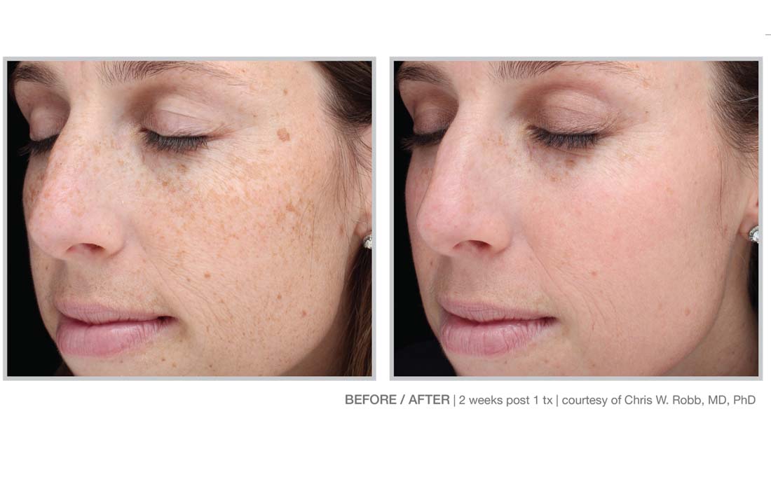Halo Laser and BBL Laser Treatments in Panama City at Sun Dermatology