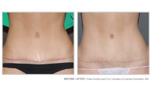 Halo Laser and BBL Laser Treatments in Panama City at Sun Dermatology