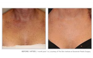 Halo Laser and BBL Laser Treatments in Panama City at Sun Dermatology