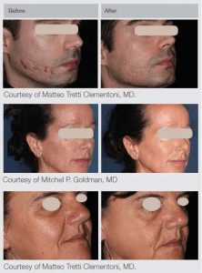 M22 Laser Treatments in Panama City at Sun Dermatology