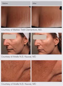 M22 Laser Treatments in Panama City at Sun Dermatology