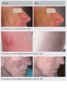 M22 Laser Treatments in Panama City at Sun Dermatology