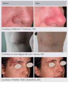 M22 Laser Treatments in Panama City at Sun Dermatology