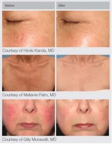 M22 Laser Treatments in Panama City at Sun Dermatology