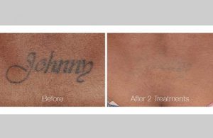 Tattoo Removal in Panama City, Florida at Sun Dermatology