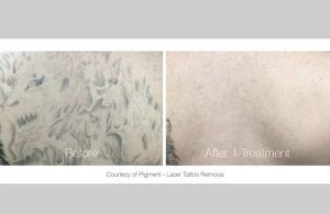 Tattoo Removal in Panama City, Florida at Sun Dermatology