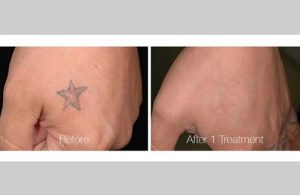 Tattoo Removal in Panama City, Florida at Sun Dermatology