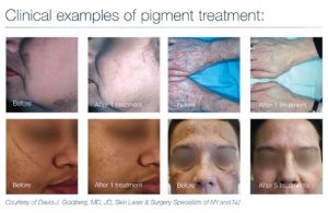 Tattoo Removal in Panama City, Florida at Sun Dermatology