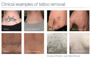 Tattoo Removal in Panama City, Florida at Sun Dermatology