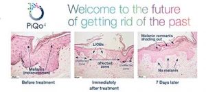 Tattoo Removal in Panama City, Florida at Sun Dermatology
