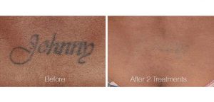Tattoo Removal in Panama City, Florida at Sun Dermatology