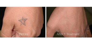 Tattoo Removal in Panama City, Florida at Sun Dermatology
